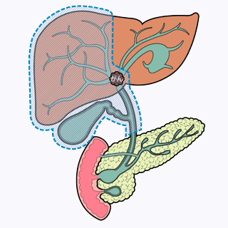 肝切除＋肝外胆管切除