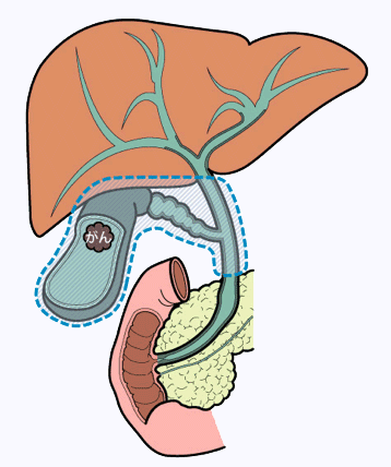 胆嚢がんの手術