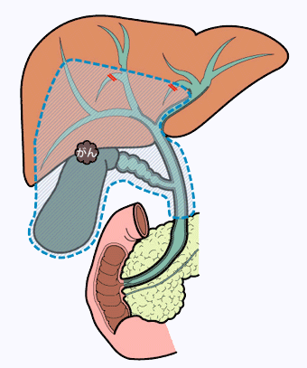 胆嚢がんの手術
