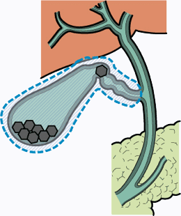 胆石症、胆嚢炎、胆嚢ポリープ