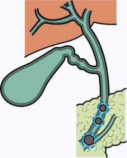 胆石症、胆嚢炎、胆嚢ポリープ