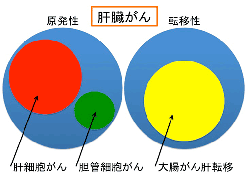 肝臓の腫瘍について