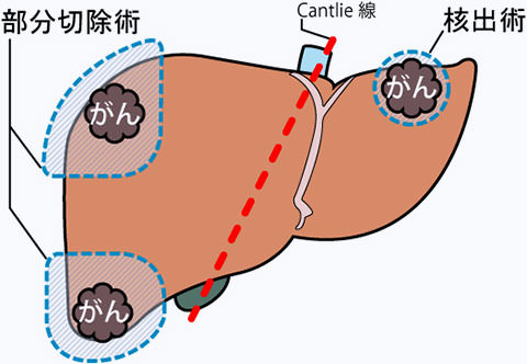 肝部分切除