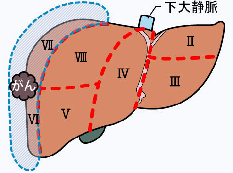 肝区域切除