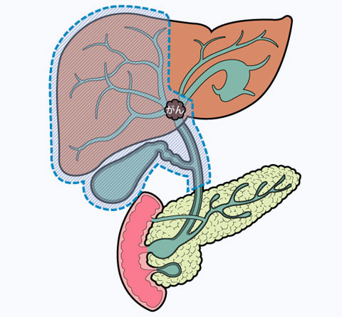 肝外胆管切除