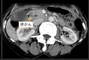 ＣＴ検査：膵頭部に約2ｃｍの腫瘤を認めます。