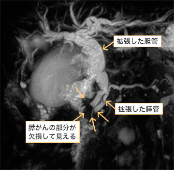 ＭＲＣＰ：膵管、胆管が膵がんにより閉塞し、拡張していることがわかります。