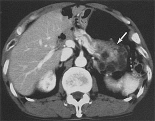 ＣＴ検査：膵頭部に約2ｃｍの腫瘤を認めます。