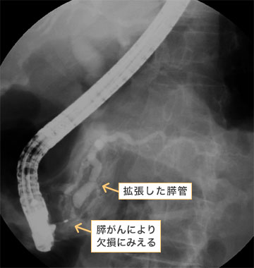 内視鏡的膵管造影。