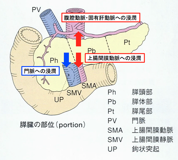 局所進行膵がん