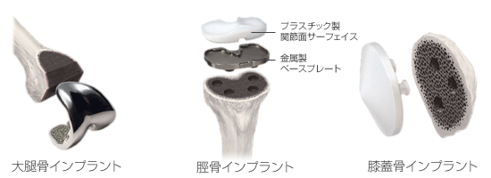 人工関節の種類