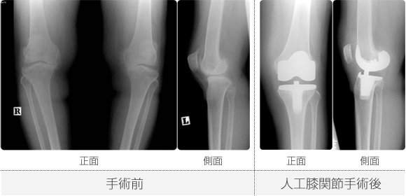 手術後のレントゲン写真