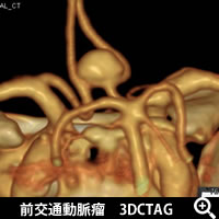 前交通動脈瘤3DCTAG