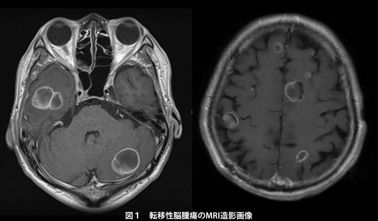 癌 頭 に 転移