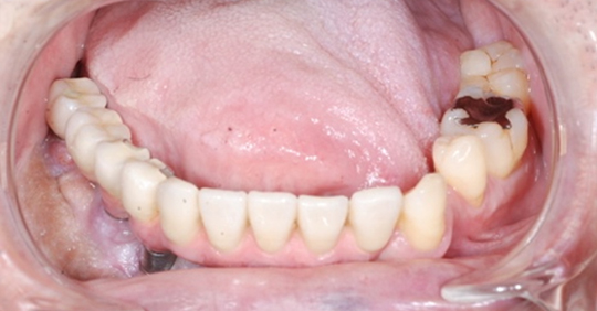 治療後の口腔内（下顎）