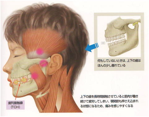 顎 関節 症 治療