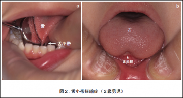 現在における舌小帯短縮症の考え方と対応 国立大学法人 東京医科歯科大学