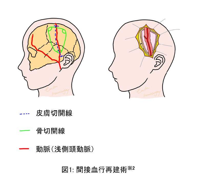 小児もやもや病における間接血行再建術後の脳室吻合チャネル退縮 ...