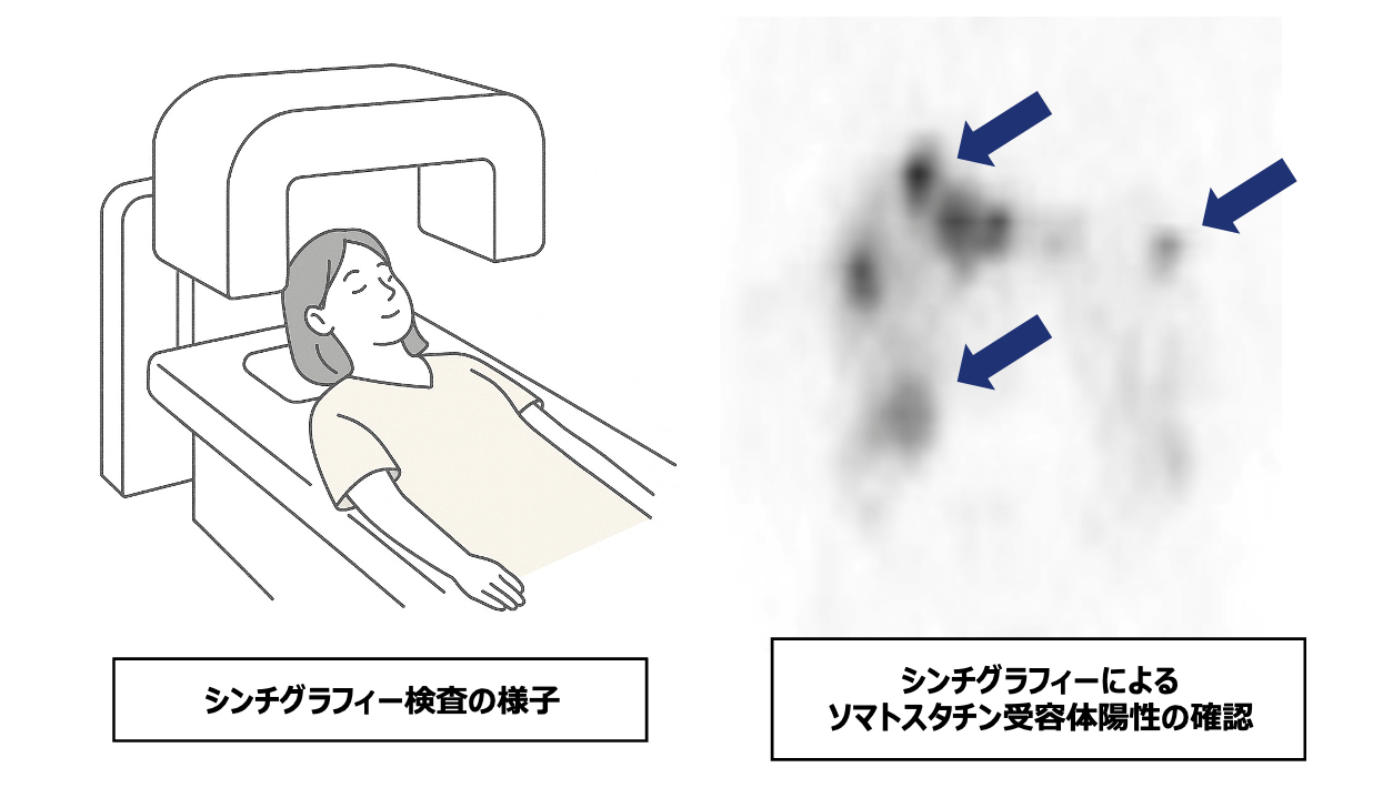 ルタテラ治療対象となる方