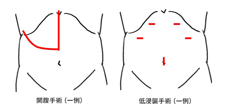 開復手術と低侵襲手術