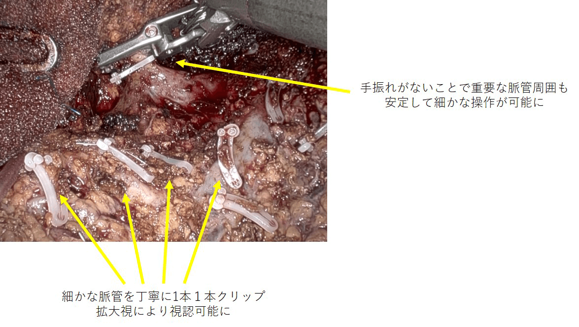 精密で安全な手術操作