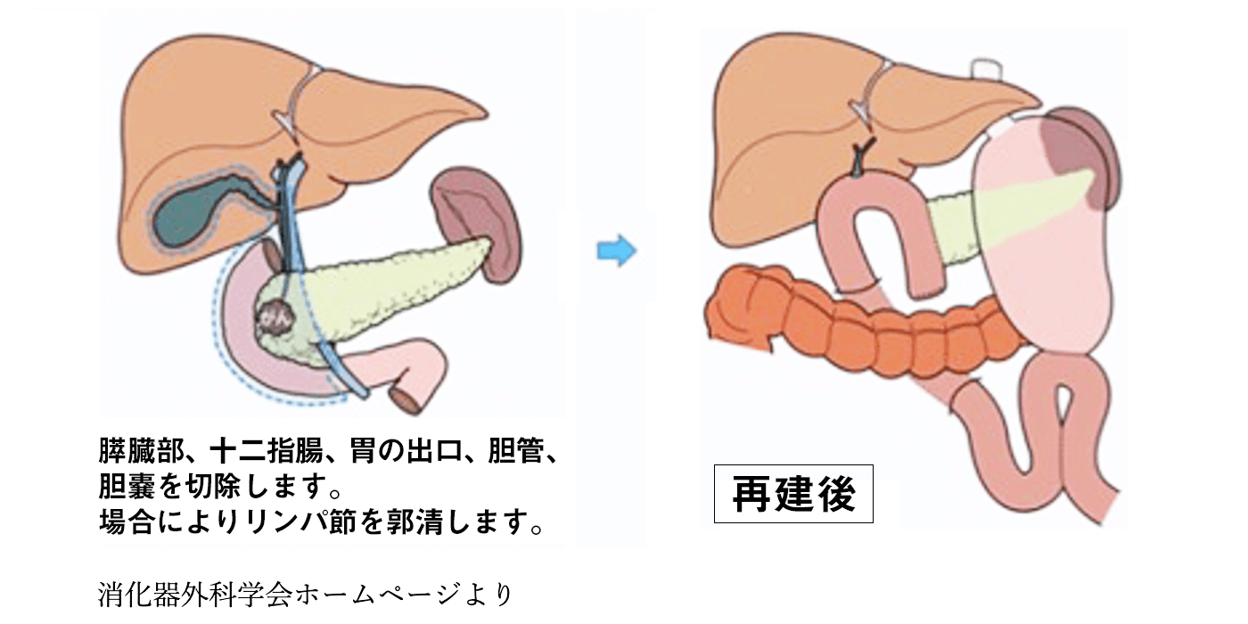 ロボット支援下膵頭十二指腸切除術の手術経過
