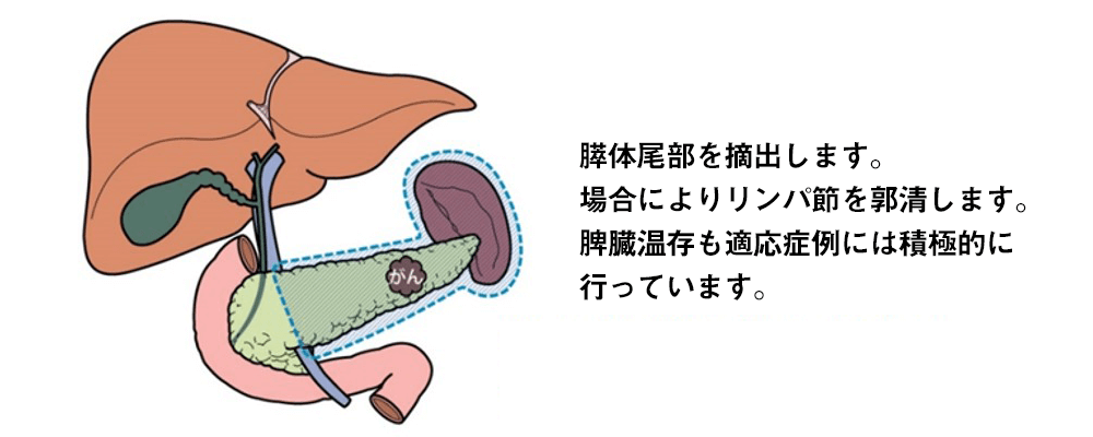 ロボット支援下膵体尾部切除術(RDP)