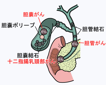 胆道の名称と疾患の部位