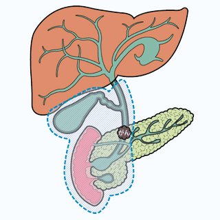 膵頭十二指腸切除について