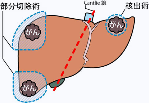 肝臓の手術：肝臓の病気と治療 | 東京医科歯科大学肝胆膵外科