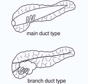 図2：主膵管型（上）と分枝型（下）