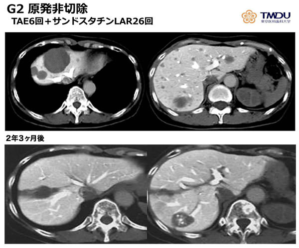 G2原発非切除