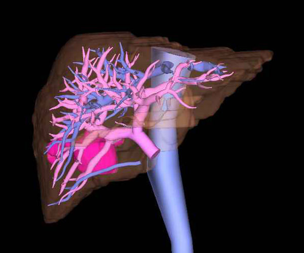 肝切除における3次元画像支援ナビゲーション