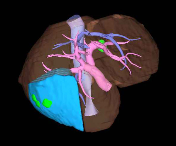 肝切除における3次元画像支援ナビゲーション