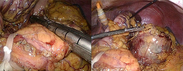 腹腔鏡下膵切除術手術