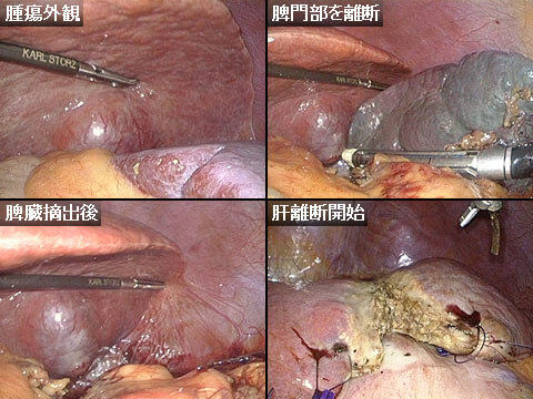 腹腔鏡下肝外側区域部分切除、脾臓摘出術