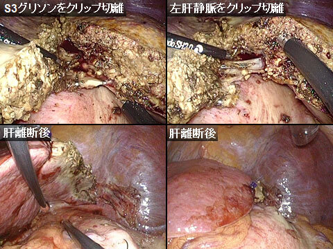 腹腔鏡下肝外側区域部分切除、脾臓摘出術