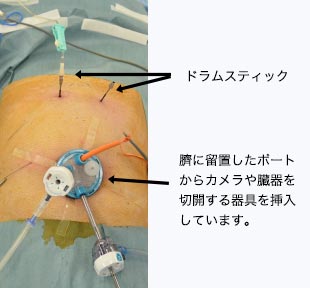 臍に留置したポートからカメラや臓器を切開する器具を挿入しています。
