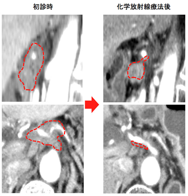 初診時と化学放射線治療後