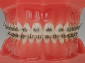 歯列矯正器具