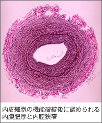 内皮細胞の機能破綻後に認められる内膜肥厚と内腔狭窄