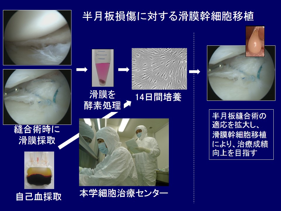 滑膜幹細胞による半月板縫合後の治癒促進