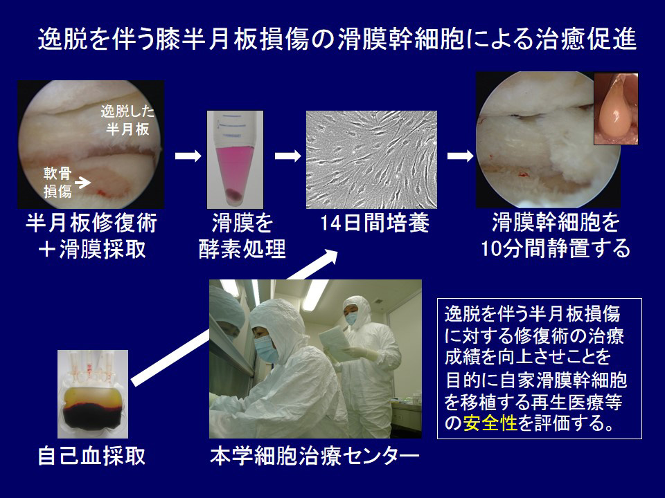 逸脱を伴う膝半月板損傷の滑膜幹細胞による治癒促進（終了）