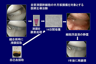 自家滑膜幹細胞の半月板損傷を対象とする医師主導治験