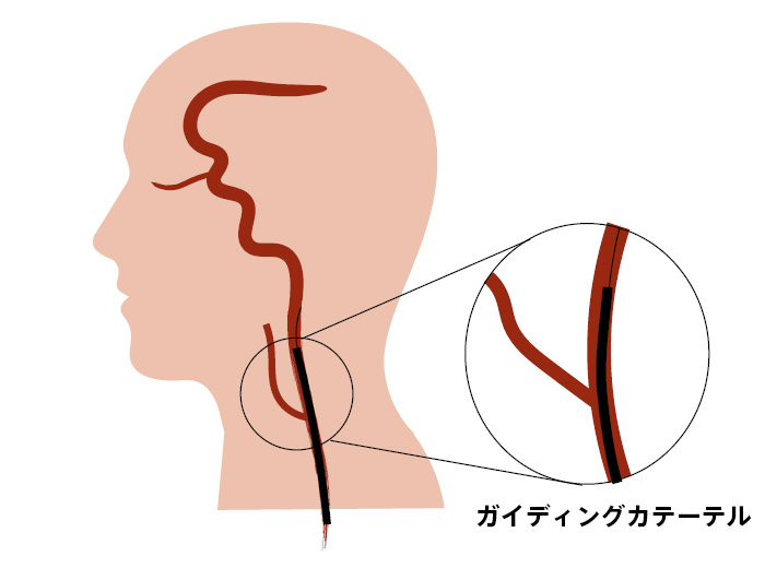 脳 動脈 瘤 消える