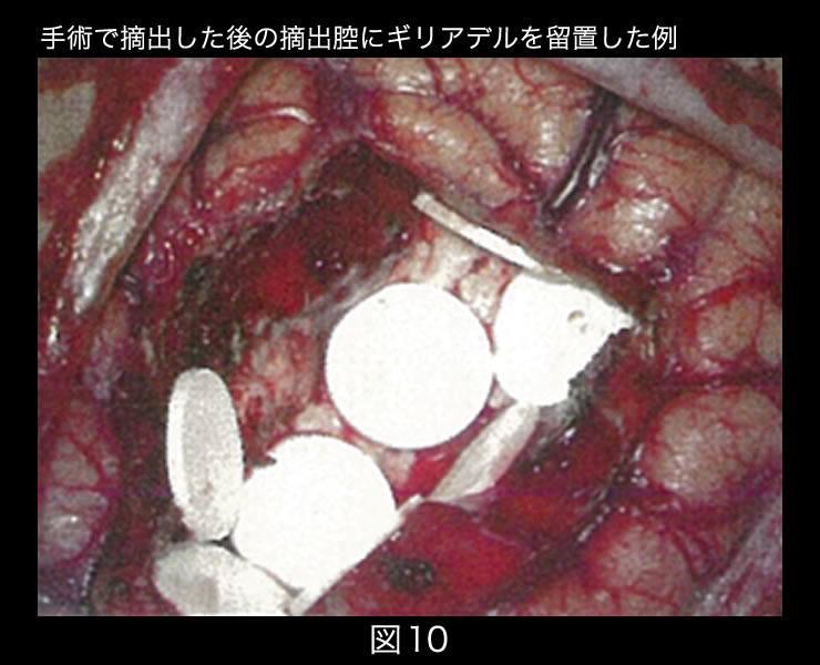 神経膠症