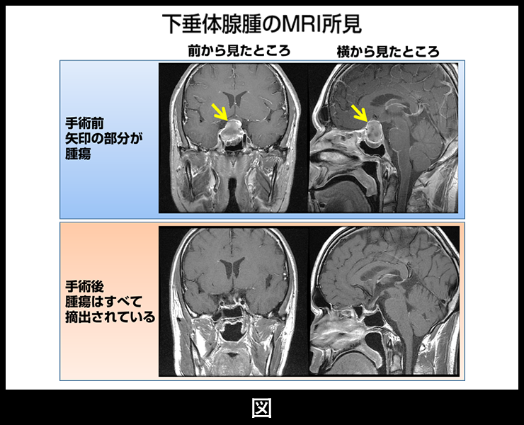 腫瘍とは何ですか?