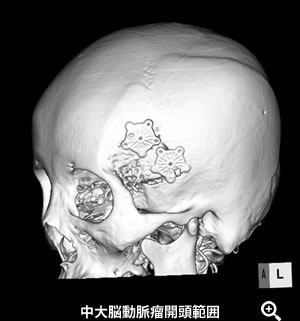 中大脳動脈瘤開頭範囲