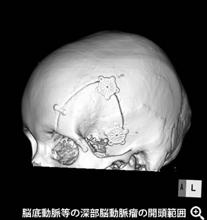 脳底動脈等の深部脳動脈瘤の開頭範囲