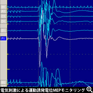 電気刺激による運動誘発電位MEPモニタリング